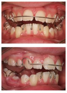 Twin block braces